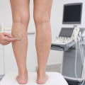 Cómo mejorar el aspecto de las piernas con varices: opciones, hábitos y expectativas