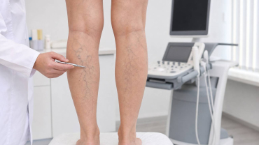 Cómo mejorar el aspecto de las piernas con varices: opciones, hábitos y expectativas